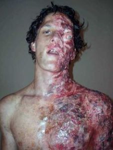 A picture of the victim, immediately upon arrival to the hospital